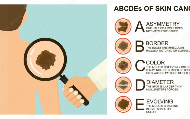 Skin Cancer